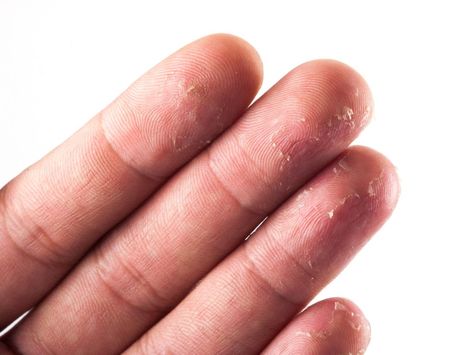 Skin peeling on fingertips: 10 causes Peeling Fingertips, Combination Skin Makeup, Skin Peeling On Face, Dry Skin Body, Dry Skin On Face, Dry Winter Skin, Face Scrub Homemade, Natural Skin Care Routine, Peeling Skin