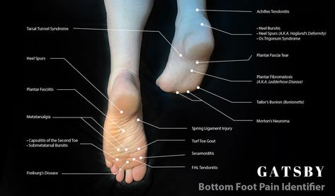 Foot Pain Chart: An In-Depth Guide to Identifying Foot Pain – GatsbyShoes Foot Pain Chart, Metatarsal Fracture, High Ankle Sprain, Pain Chart, Sprained Ankle, Calf Muscles, Heel Pain, Foot Pain, Physical Health