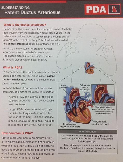 Understanding Patent Ductus Arteriosus #PDA #medicine Nicu Nursing Education, Nicu Nurse Education, Drawing Chicano, Patent Ductus Arteriosus, Neonatal Nurse Practitioner, Nursing School Scholarships, Newborn Nursing, Pediatric Nurse Practitioner, Picu Nurse