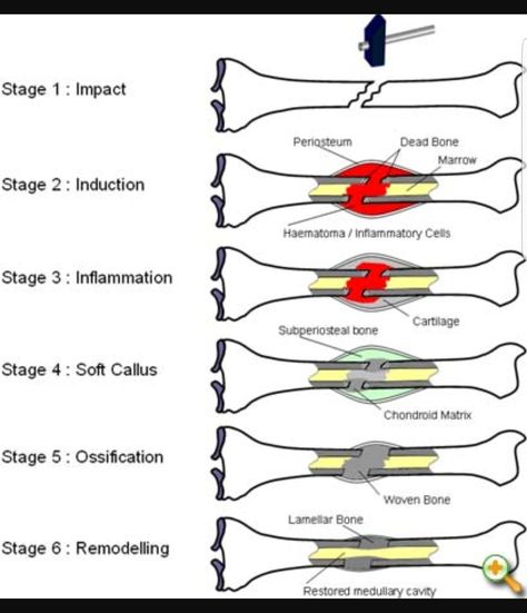 Bone Physiology, Muscular System Anatomy, Fracture Healing, Orthopedic Nursing, Bone Healing, Medical Sales, Bone Fracture, Basic Anatomy And Physiology, Nursing Mnemonics