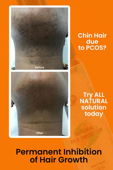 chin hair
hair removal
permanent hair removal
hair inhibitor
serum
before after Natural Hair Removal Remedies, Dry Hair Mask, Get Long Hair, Chin Hair Removal, Female Facial Hair, Hair Growth Inhibitor, Serum For Hair, Ingrown Hair Removal, Chin Hair