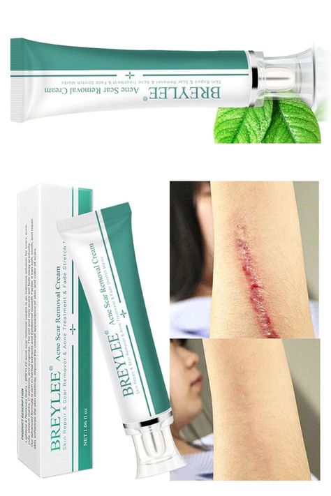 Stretch Mark Cream Pregnancy, Face Pimples, Acne Scar Removal Cream, Hypertrophic Scars, Scar Removal Cream, Pimple Scars, Scar Cream, Oily Skin Acne, Pimples On Face