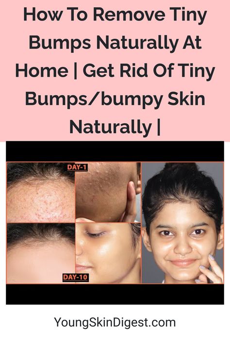 How To Remove Tiny Bumps Naturally At Home | Get Rid Of Tiny Bumps/bumpy Skin Naturally | How To Remove Bumps On Face, How To Get Rid Of Face Bumps, Bumpy Face Skin, How To Get Rid Of Bumpy Skin On Face, Bumpy Skin Remedies, How To Get Rid Of Bumpy Skin, How To Clear Bumps On Face, Face Bumps Get Rid Of, How To Get Rid Of Forehead Bumps