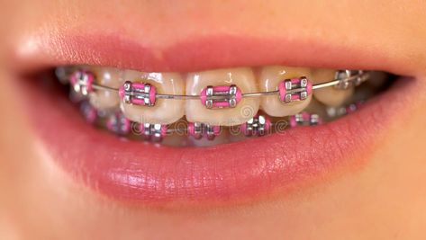 Dental Braces Colors, Pink Braces, Cute Braces Colors, Types Of Braces, Kids Braces, Braces Tips, Getting Braces, Braces Girls, Cute Braces