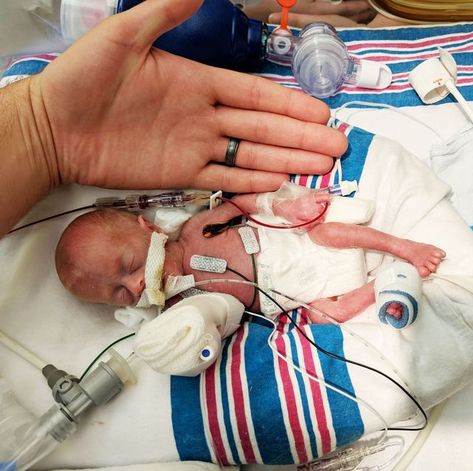 Medical procedure, Child, Baby, Birth, Childbirth, Patient, Hand, Preemie Babies Pictures, Injection Hand Pic, Premie Baby, Nursing School Motivation, Premature Birth, Preemie Baby, Micro Preemie, Miracle Baby