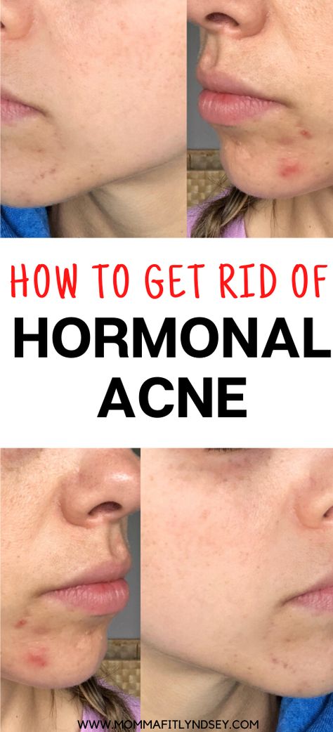 How to Get Rid of Hormonal Acne or Cystic Acne Naturally.  Get rid of chin acne with gut healing foods and natural products Acne Chin And Jaw, How To Get Rid Of Redness On Face From Acne, Home Remedy For Face Acne, Cystic Hormonal Acne, Cystic Acne Diet Plan, Deep Acne Remedies, How To Keep Your Face Acne Free, Clear Chin Acne, Clyndamiacin For Acne