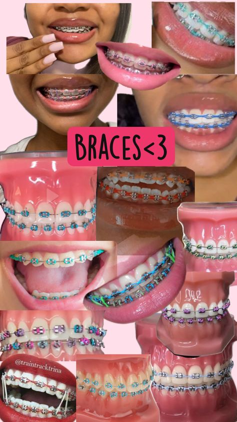 Dental Braces Colors, Braces Colors Combinations, Braces Ideas, Pink Braces, Cute Braces Colors, Pretty Teeth, Braces Tips, Getting Braces, Cute Braces