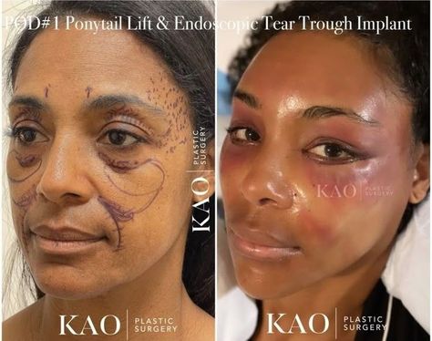 Eyebrow Lift Surgery, Eye Lift Surgery, Face Injections, Face Plastic Surgery, Plastic Surgery Fail, Rhinoplasty Nose Jobs, Face Surgery, Plastic Surgery Gone Wrong, Beauty Procedures