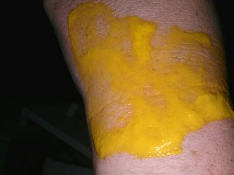 Blister-free burn reliever...MUSTARD??? Yep! Just apply a nice layer to the burn, let it dry, and wash w cool water. There may be a small red area, however, no pain & no blister. Love me some mustard. Get Rid Of Bruising Fast, Burn Blister, Mustard For Leg Cramps, Heal Bruising Quickly, Honey Tumeric Ginger Vanilla Antibiotic, Health Remedies, Home Remedies, Life Hacks, How To Apply