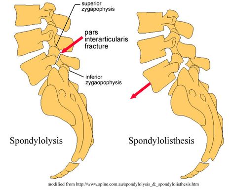 Pars4 Fractures of the L4 L5 sponylolysis and sponylolisthesis Cervical Spondylosis, Medical Imaging, Medical Anatomy, Sprained Ankle, Anatomy And Physiology, Physical Therapy, Chronic Pain, Back Pain, Bones