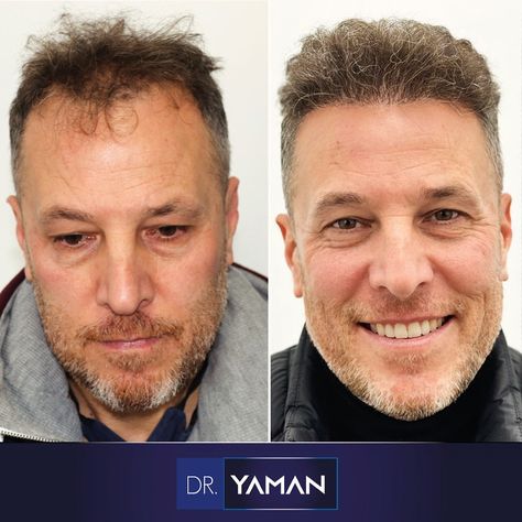 You can watch the 4760 grafts hair transplant before and after 2 years results video at Dr. Resul Yaman Hair Transplant Clinic in Istanbul. The patient visited our clinic two years ago, expressing a desire to find a solution for hair thinning on the temples and crown.  Dr. Resul Yaman used the DHI hair transplant method for the patient, implanting 1280 single, 2460 double, and 1020 triple grafts. Hair Transplant Cost, Hair Transplant Procedure, Best Hair Transplant, Hair Thinning, Cheap Hair Products, The Patient, Hair Restoration, Hair Transplant, Hair Strand