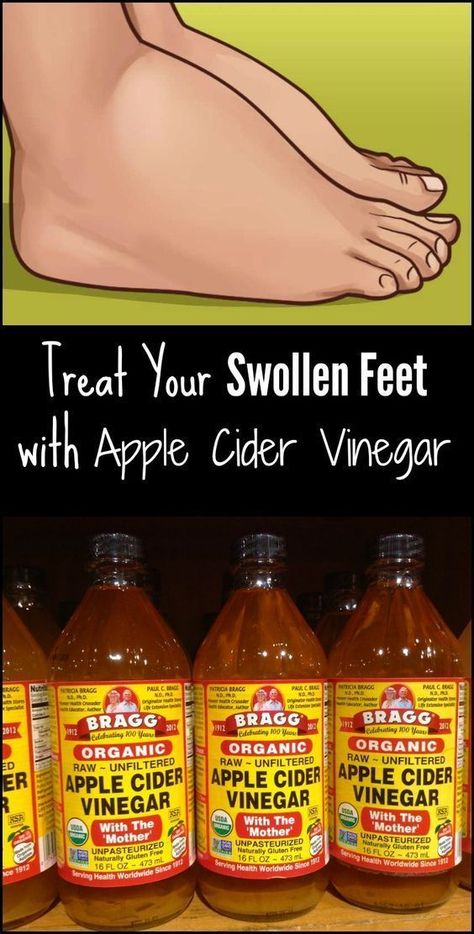 Treat Your Swollen Feet with Apple Cider Vinegar Swelling Feet Remedies, Feet Remedies, Apple Cider Vinegar Remedies, Water Retention Remedies, Uric Acid, Diet Vegetarian, Detox Juice, Back To Nature, Regular Exercise