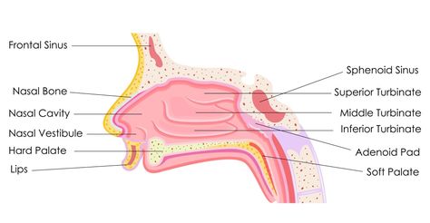 Sinus passages.  Sinusitis and upper airway symptoms in bronchiectasis.  Rhinosinusitis is inflammation of the nasal passages and paranasal sinuses, which leads to a build-up of mucus production which may increase the risk of infection (Fig.1).  Upper airway symptoms in the form of rhinosinusitis may present in some people with bronchiectasis. Paranasal Sinuses, Nasal Obstruction, Chronic Sinusitis, The Respiratory System, Upper Respiratory Infection, Chronic Obstructive Pulmonary Disease, Nasal Passages, Nasal Spray, Sinus Infection