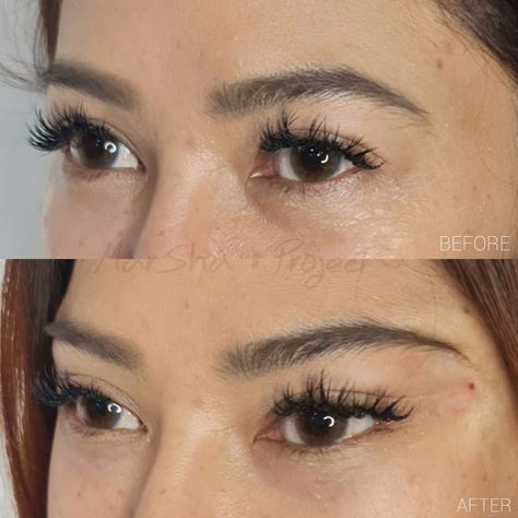 Fox Eye Lift Surgery, Cat Eye Surgery Before And After, Fox Eye Surgery, Beauty Surgery, Eye Lift Surgery, Brow Lift Surgery, Foxy Eyes, Natural Skin Tightening, Botox Before And After