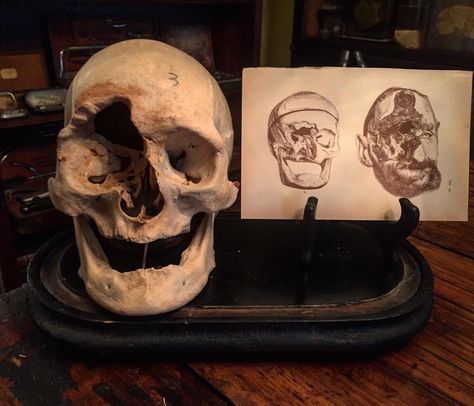 Deformed Skull, Medical Antiques, Human Skull, The Skull, Medical History, Anatomy Art, Weird World, Instagram Likes, Skull Tattoo