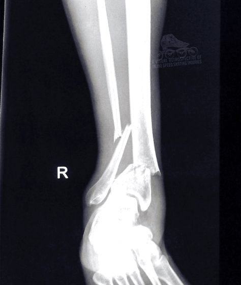 #ankle #fracture #xray #inlinespeedskating #injury #bones #broken Xray Pictures, Disease Aesthetic, Jones Fracture, Rad Tech Student, Ankle Ligaments, Ankle Fracture, Radiology Student, Broken Ankle, Bone Fracture