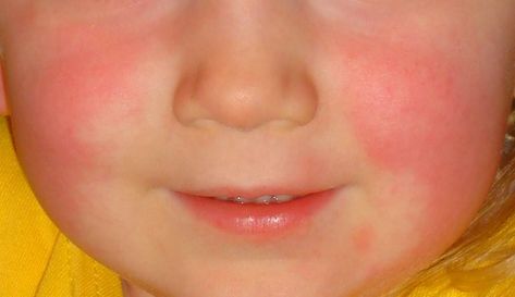 Common Baby Rashes, baby rash on face, baby rash remedies, baby rash on neck, diaper rash remedies. Red Rash, Strep Throat, Ehlers Danlos Syndrome, Serious Illness, Skin Allergies, Abdominal Pain, Signs And Symptoms, Natural Treatments, Warning Signs