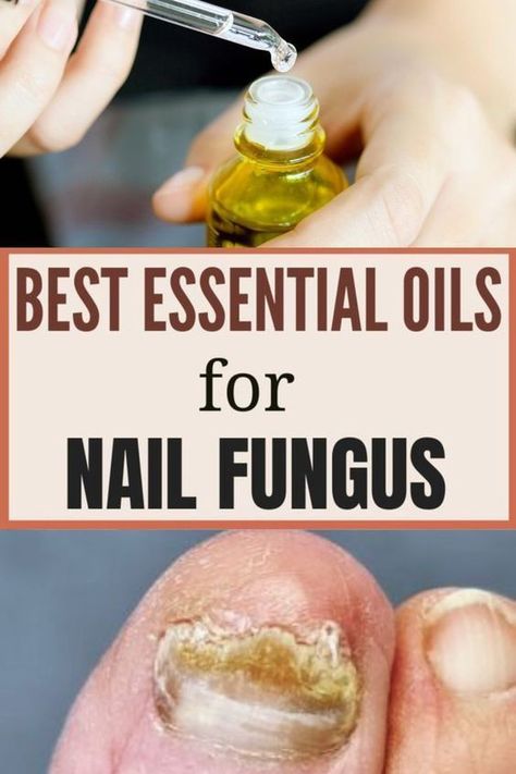 Fungal Nail Infections Fungal Infection Remedies, Infected Toenail, Nail Remedies, Toenail Fungus Remedies, Nail Fungus Remedy, Nail Infection, Fungal Nail, Nail Oil, Toenail Fungus