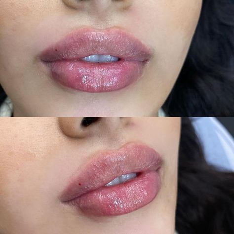 Lip Fillers Round, Lip Filler Shape Ideas 1ml, Lip Filler Shape Ideas, Russian Lip Filler, Lip Fillers Juvederm, 1ml Lip Filler, Lip Goals, Filler Aesthetic, Juvederm Lips