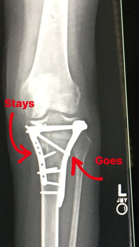 So on Tuesday, I'm sitting at my orthopedic surgeon 11 month follow up appointment nervous as all hell. Tibial Plateau Fracture, Orthopedic Surgeon, Shin Splints, Walking Exercise, Secure Attachment, After Surgery, Surgery, How To Memorize Things