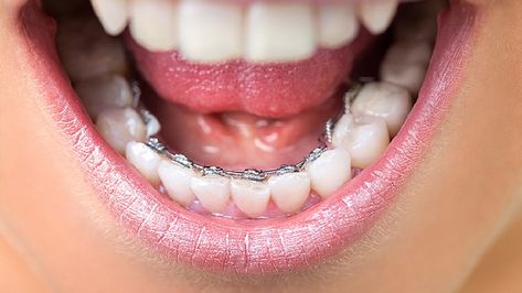 There are so many options available to those who want to get their teeth straightened today, including lingual braces. But what are lingual braces? Invisible Teeth Braces, Lingual Braces, Braces Cost, Types Of Braces, Invisalign Braces, Traditional Braces, Invisible Braces, Clear Braces, Teeth Whitening Diy