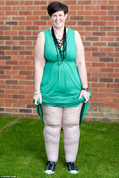 Obese mother is left with 'tree trunk' legs due to rare condition despite drastic weight loss | Daily Mail Online Big Legs, Jackets Men Fashion, Jacket Style, Men's Jacket, Style Guides, Trunk, Outfit Of The Day, Tree Trunk, Winter Outfits