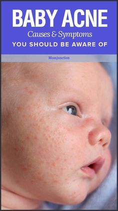 Baby Acne: What Causes Them And How You Can Prevent : Do you notice a sudden spurt of blisters on your newborns face? There can be chances of baby acne. Know the causes #symptoms #treatments & #home #remedies. Baby Acne Remedy, Newborn Acne, Rash On Face, Baby Acne, Heat Rash, Acne Causes, Mom Junction, Baby Massage, Baby Health