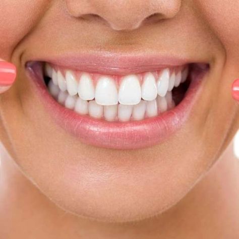 Beautiful smile/teeth shape Teeth Aesthetic, Pretty Teeth, Tooth Ache Relief, Veneers Teeth, Discolored Teeth, Beautiful Teeth, Straight Teeth, Perfect Teeth, Teeth Shape