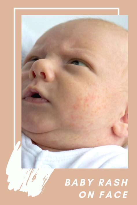 Heat Rash On Face, Face Rash Remedies, Baby Rash On Face, Baby Heat Rash, Home Remedies For Rashes, Home Remedies For Face, Rash On Face, Sunburn Relief, Kids Allergies