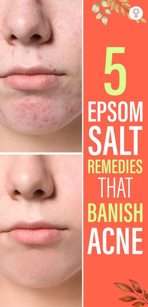 5 Epsom Salt Remedies That Banish Acne: Epsom salt contains some really good antiseptic qualities, which help in clearing your skin of impurities. In addition to that, it has a myriad of properties that make it the perfect acne remedy. #skincare #skincaretips #acne #epsomsalt Bacterial Acne Remedies, Backne Remedies, Quick Acne Remedies, Why You Get Acne In Certain Areas, Chest Acne Remedies, Nose Acne, Skincare Tips Beauty Secrets, Acne Skin Care Products, Fungal Acne Vs Bacterial Acne