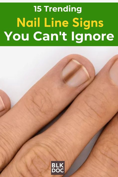 Trending Nail Line Signs You Can't Ignore Line On Nails, Nail Health Signs, Black Doctor, Nails Health, Health Signs, Lines On Nails, Nail Health, A Doctor, You Nailed It