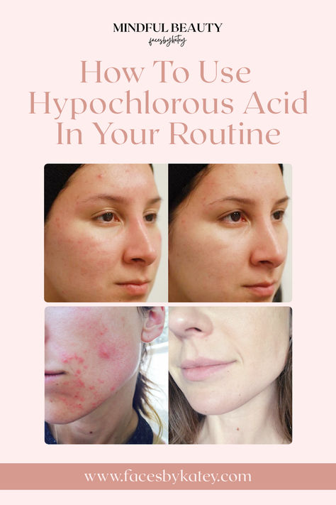 One recent rising star in the skincare realm is hypochlorous acid. This powerful yet gentle compound is making waves for its numerous uses for the skin and conditions such as acne and eczema. Learn how to use this in your skincare routine! Hypochlorous Acid, Hydrochloric Acid, Dry Flaky Skin, Acne Serum, Skin Care Order, Flaky Skin, Acne Skin, Skin Healing, Making Waves