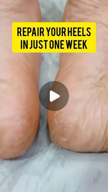 Home Remidies on Instagram: "Now repair your crack heels. Follow @homeremidies202 for more #skincaretips #home #skin #trending #follow4followback #fyp" Heel Cracks Remedies, Cracked Heels Remedy, Cracked Heel Remedy, Potato For Skin, Cracked Heel Remedies, Viral Skincare, Skincare Selfcare, Dried Lemon, Foot Scrub