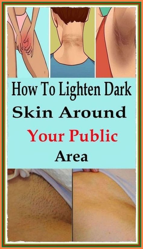 Tips for a Lighter Skin On Your Pubic Area! Clear Skin Care Routine, Skin Lightening Diy, Sagging Cheeks, Clear Skin Care, Spots On Skin, Healthy Woman, Dark Armpits, Natural Mask, Healthy Life Hacks