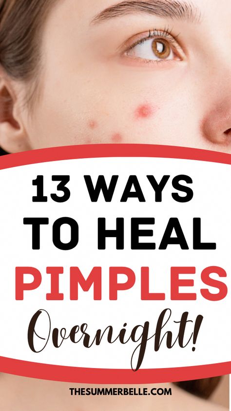 13 Best Tips to get rid of Pimples fast in 2023 - The Summer Belle #acne #pimples #pimplesremedies #acneremedies #skincarediy. https://whispers-in-the-wind.com/combatting-pimples-under-the-skin-expert-tips-and-product-recommendations/?51 Dry Out Pimples Overnight, Quick Ways To Get Rid Of Pimples, Red Pimple Remedy Fast, Get Rid Of Redness From Pimples, Best Way To Get Rid Of Pimples Overnight, Getting Rid Of Pimples Fast, Ways To Get Rid Of Pimples Overnight, How To Get Rid Of Red Pimples Fast, How To Get Rid Of Big Pimples Overnight