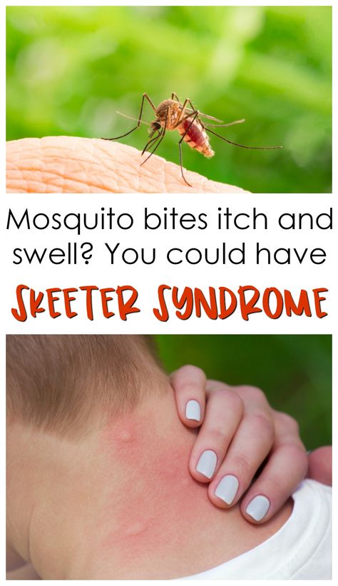 Mosquito Bites Sting And Swell? You Could Have Skeeter Syndrome. Yup, being allergic to mosquitos is a real thing. Here's what you need to know about the condition! Skeeter Syndrome, Allergic To Mosquito Bites, Mosquito Bite Itch, Calamine Lotion, Anaphylactic Shock, Mosquito Bites, Asthma Symptoms, Bee Sting, Genius Ideas