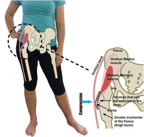 Gluteal Tendinopathy - This problem is much more common in women, particularly after or around the time of menopause. It is thought that estrogen has some protective effect on tendons, that is reduced after menopause. A common story we hear from our patients, is that the pain started with a combination of hormonal change during menopause, weight gain during this time and a sudden increase in activity levels to help control weight gain. Gluteal Tendinopathy, Greater Trochanteric Pain Syndrome, Hip Anatomy, Back Pain Stretches, Hip Flexor Exercises, Bursitis Hip, Hip Pain Relief, Hip Problems, Back Stretches For Pain