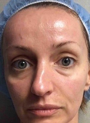 Under Eye Prp Before And After, Prp Before And After, Prp Injections Under Eyes, Prp Undereye Before And After, Prp Face Before And After, Prf Injections, Prp For Face, Prp Injection, Prp Facial