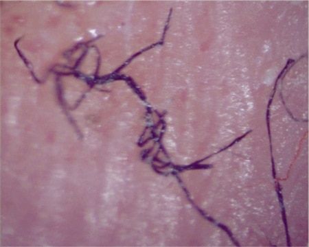 NBC Tells Truth On Morgellons Hell! | Light On Conspiracies - Revealing the Agenda Diseases Pictures, Skin Parasites, Skin Condition, Skin Disorders, Fungal Infection, Skin Diseases, Nanotechnology, Health Articles, Medical Professionals