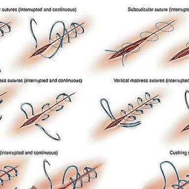 Medical Doctors | Different types of surgical sutures . #medicalstudent #doctor #surgery #surgeon #clinical #medicalschool | Instagram Surgical Suture, Surgical Tech, Medical Students, Doctor Medical, Medical School, Different Types, Surgery, Health Care, Medical