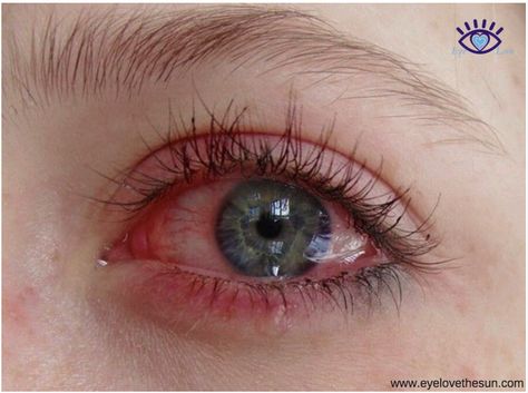 Learn what you can do to lessen the effects of allergies click visit to learn more! #eyelovethesun #allergy #optometrist Crying Eyes, Carrie White, Eye Photography, Aesthetic Eyes, Pretty Eyes, Eye Art, 인물 사진, Red Eyes, Eye Drawing