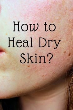 Tips to heal dry and itchy skin. Dry Skin Makeup, Brown Spots On Skin, Healing Dry Skin, Extremely Dry Skin, Dry Skin On Face, Dry Skin Remedies, Scaly Skin, Combination Skin Type, Dry Itchy Skin