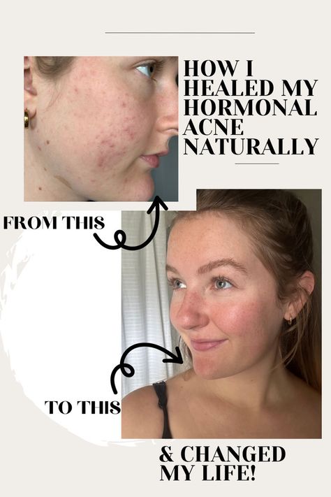 Hormonal acne is not fun at all.. and to be honest, neither is the healing journey. But it is so worth it to learn how to tune into your body, and make necessary changes for your health and life! Healing acne naturally. Coming Off Birth Control, Healthy Skin Routine, Healing Acne, Mild Acne, Healthy Skin Care Routine, Hormonal Birth Control, Beauty App, Body Acne, Hormonal Acne