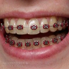 Vino Red Braces Color, Perfect Teeth Braces, Braces Transformation, Braces Colors Combinations, Fake Braces, Red Braces, Cute Braces Colors, Adult Braces, Kids Braces