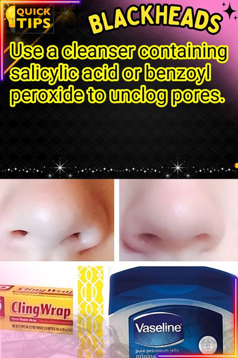 Banish Blackheads with This Simple Vaseline Trick Benzoyl Peroxide, Unclog Pores, Salicylic Acid, Vaseline, Blackheads, Pins