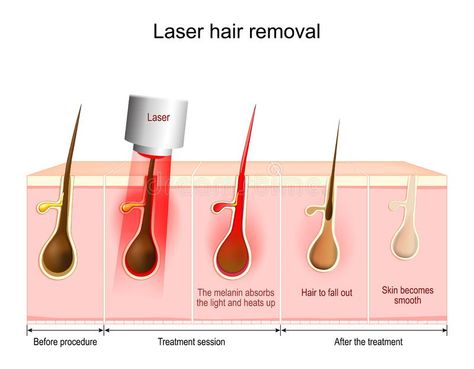 Laser Hair Removal Marketing Ads, Laser Illustration, Botox Migraine, Laser Hair Removal Facts, Laser Depilation, Hair Science, Face Hair Removal, Skin And Hair Clinic, Laser Hair Removal Machine