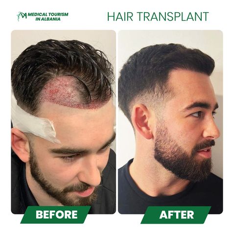 "Transforming lives, one hairline at a time. Our patient underwent a hair transplant procedure at our state-of-the-art Medical Tourism clinic in Albania and the results speak for themselves. Witness the incredible before and after transformation that has restored both confidence and a full head of hair. #HairTransplant #MedicalTourism #AlbaniaClinic #TransformingLives" Hair Transplant Procedure, Medical Tourism, Hair Transplant, Medical, The Incredibles, Hair