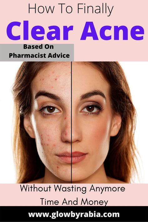 Acne Map, Acne Face Map, Clear Acne Fast, Face Map, Face Mapping Acne, Forehead Acne, Bad Acne, Acne Scarring, Pimples Remedies