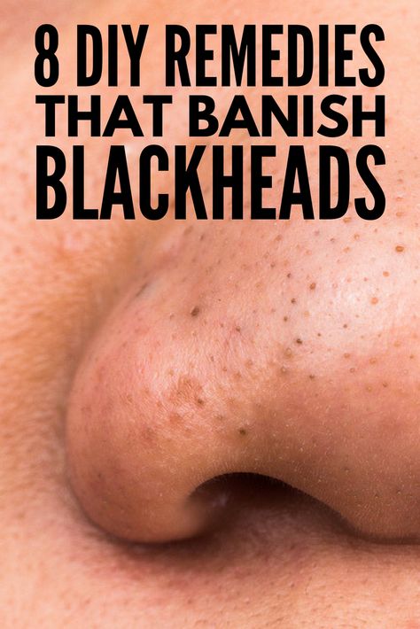 The Best Way to Remove Blackheads: 8 At Home Blackhead Removal Ideas! Hydrogen Peroxide Skin, Remove Blackheads From Nose, Blackhead Remover Diy, Blackhead Remedies, Pimples Under The Skin, To Remove Blackheads, Blackheads On Nose, Rid Of Blackheads, Remove Blackheads