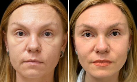 Malar bags are swelling in the area between your lower eyelids and upper cheeks. They can only be treated surgically or non-surgically. Malar Bags, Laser Skin Resurfacing, Cheek Fillers, Laser Resurfacing, Excess Skin, Upper Eyelid, Fluid Retention, Skin Resurfacing, Facial Exercises